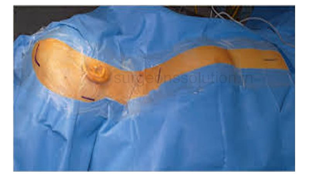 Shunt Drape Sterile