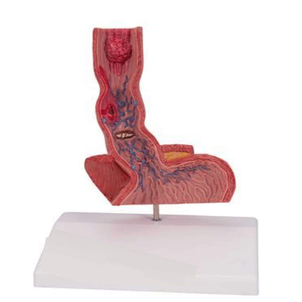 Human Esophagus Diseases Model