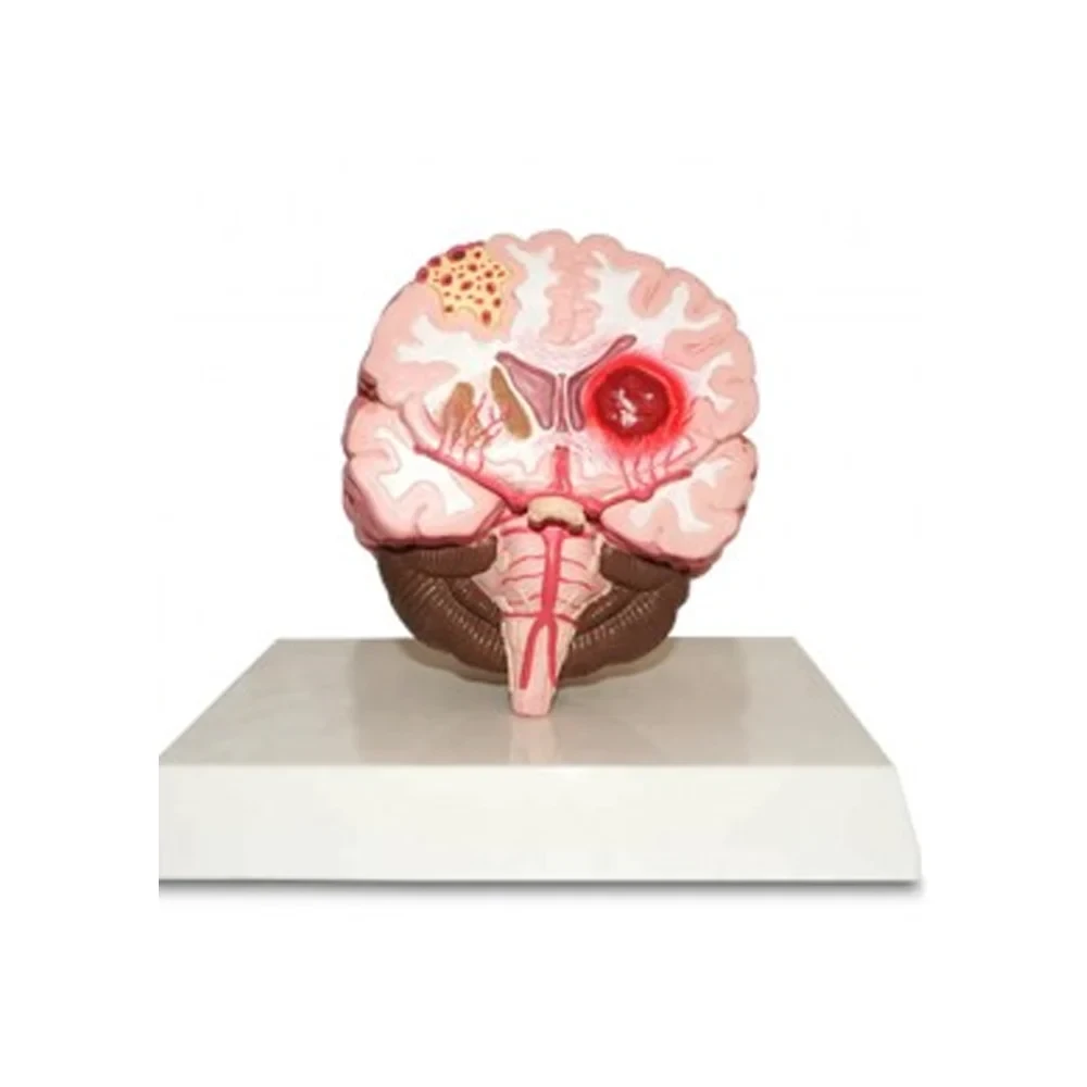 Brain Stroke Model Delux