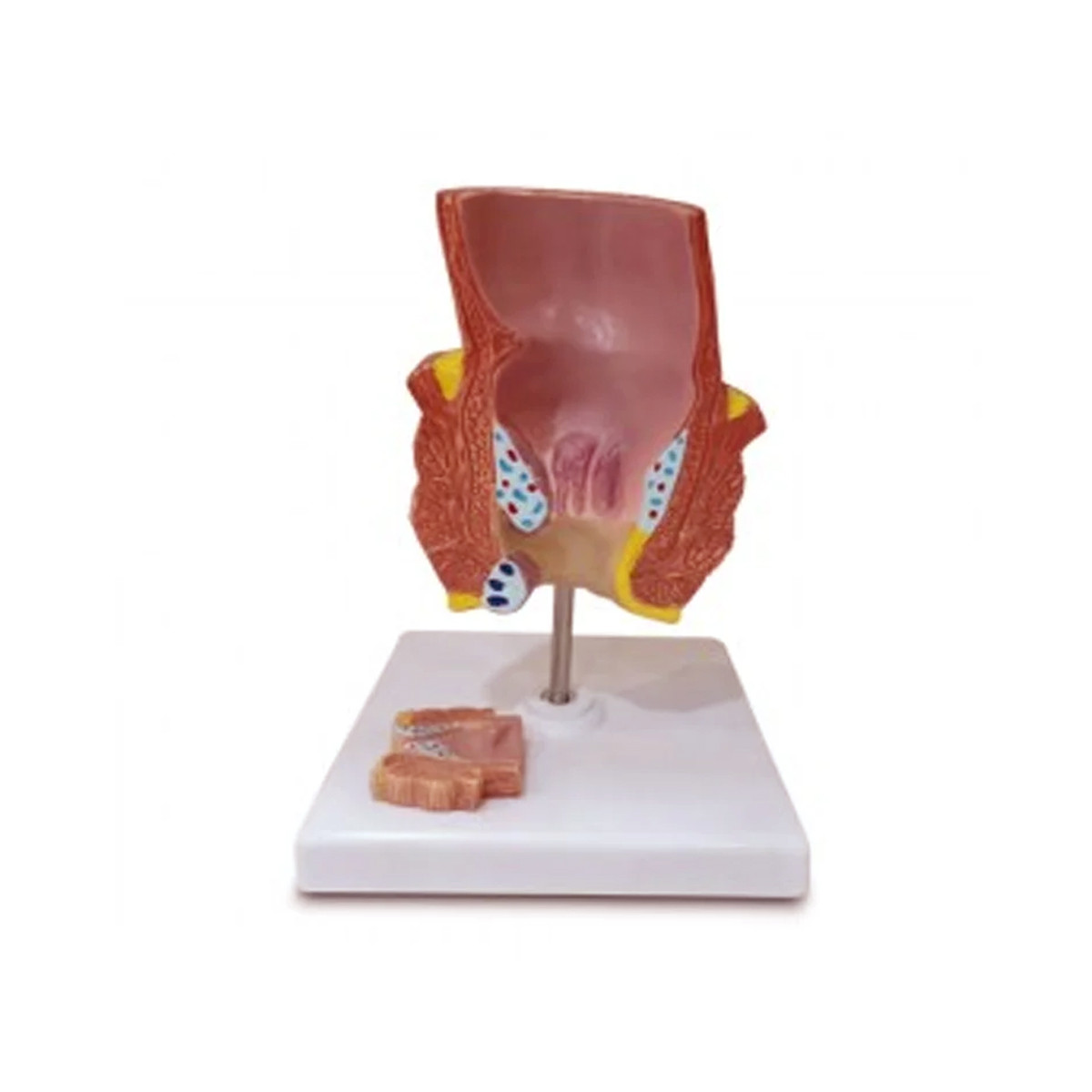 Diseased Rectum Model