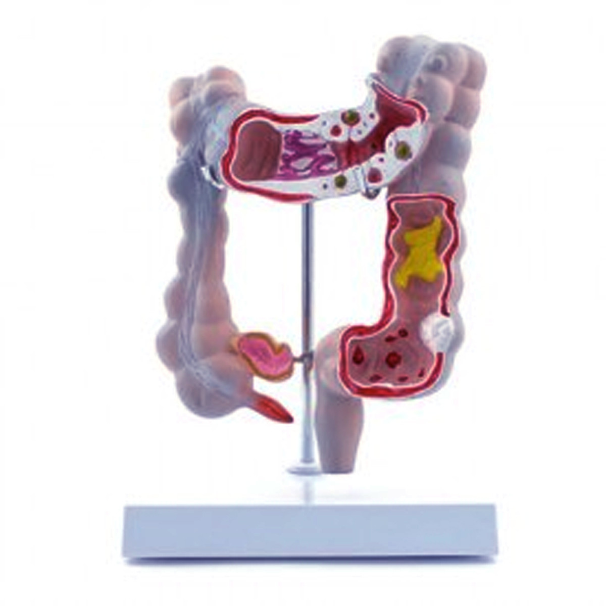 Natural Plastic Colon Pathological Model