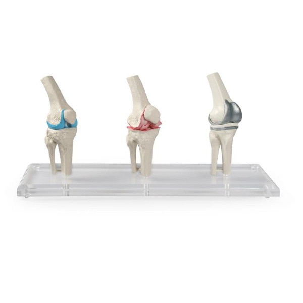 Stage Arthritis Knee Model